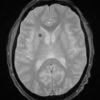 Toxoplasmosis - Hình ảnh 3