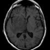 Toxoplasmosis - Hình ảnh 3