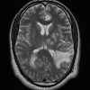 Toxoplasmosis - Ảnh 3