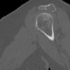 Sarcoma sụn - Ảnh 3