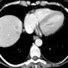 Lymphoma gan - Hình ảnh 3