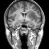 Toxoplasmosis - Hình ảnh 3