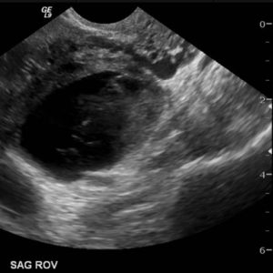 Nang buồng trứng chảy máu