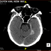 Tụ máu DMC - Hình ảnh 2