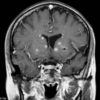 Toxoplasmosis - Hình ảnh 4