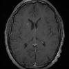 Toxoplasmosis - Hình ảnh 4