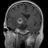 Toxoplasmosis - Hình ảnh 5