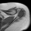 Sarcoma sụn - Ảnh 4