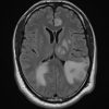 Toxoplasmosis - Ảnh 4