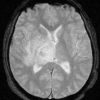 Toxoplasmosis - Hình ảnh 4