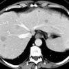 Lymphoma gan - Hình ảnh 5