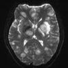 Toxoplasmosis - Hình ảnh 4