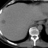Lymphoma gan - Ảnh 4