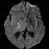 Toxoplasmosis - Hình ảnh 4