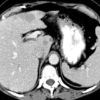 Lymphoma gan - Hình ảnh 4