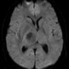 Toxoplasmosis - Hình ảnh 5