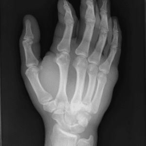 Trật khớp cổ bàn tay