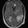 Toxoplasmosis - Ảnh 6