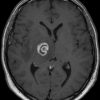 Toxoplasmosis - Hình ảnh 6