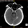 Tụ máu DMC - Hình ảnh 4