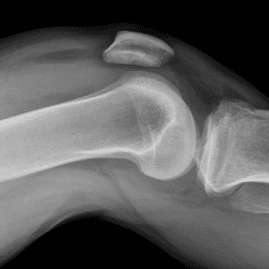 Chấn thương khớp gối