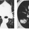 Lymphoma