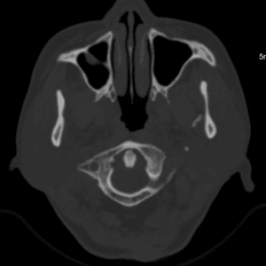 Chấn thương hàm mặt