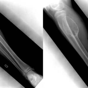 Nang xương phình mạch