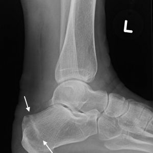 Gãy xương mệt mỏi