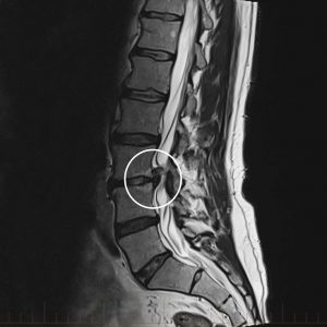 Thoát vị đĩa đệm