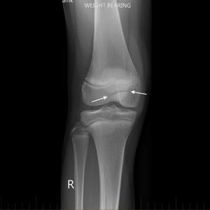 Xương bánh chè 2 mảnh