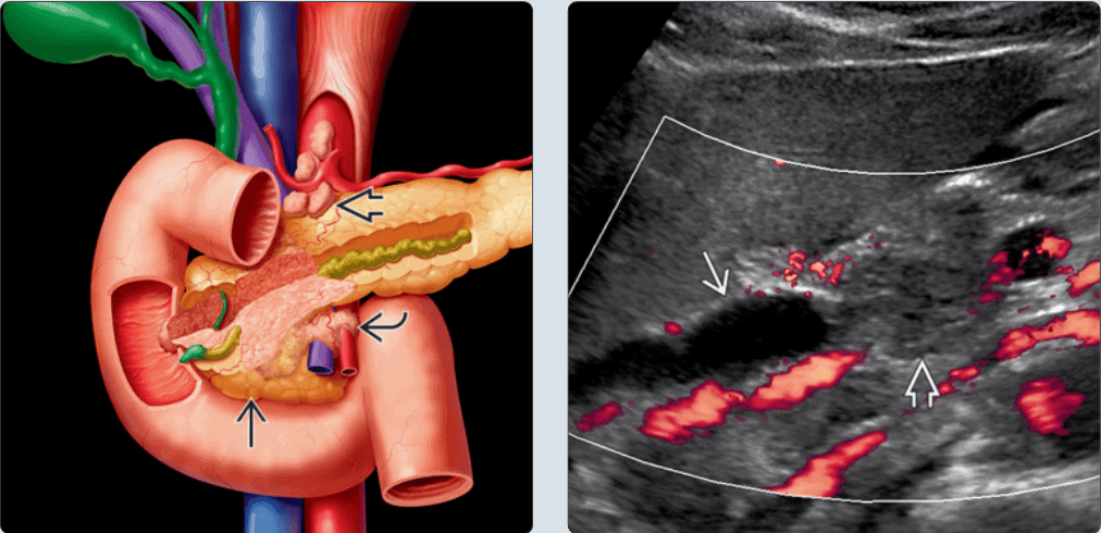 Mô hình giải phẫu tuyến tụy