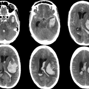 Phình động mạch não