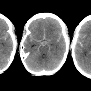 Phình động mạch não