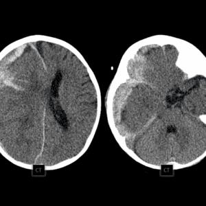 Vỡ phình ĐM não
