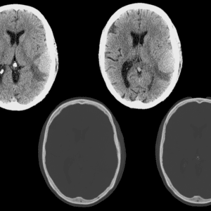 Di căn màng cứng