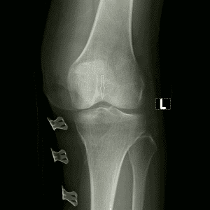 Chấn thương khớp gối