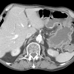 Chảy máu ổ loét dạ dày