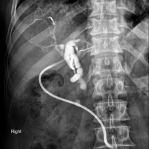 Sỏi đường mật