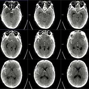 Chảy máu dưới nhện 2 bán cầu / Tụ máu não thất