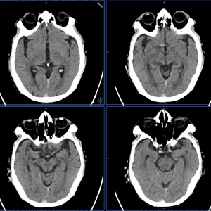 Phình động mạch não