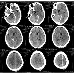 Tụ máu dưới màng cứng