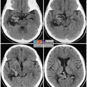 Thông động tĩnh mạch não