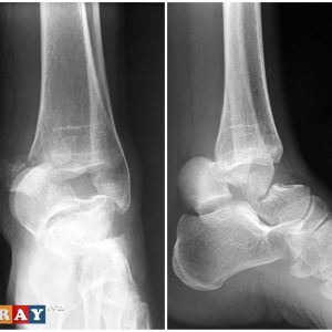 Chấn thương cổ chân