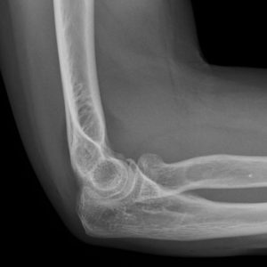 Chấn thương khuỷu tay