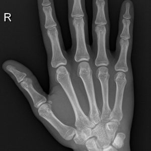 Chấn thương cổ tay