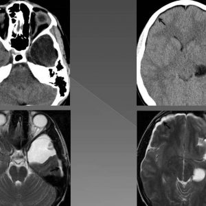 Nang màng nhện / Dịch dưới màng cứng 2 bán cầu => đè đẩy não thất và đường giữa