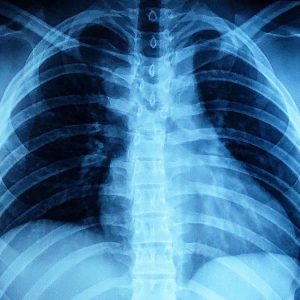 Trật khớp ức đòn