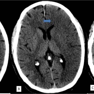 Nhập viện: nhồi máu rộng bán cầu trái thuộc vùng cấp máu ĐM não giữa