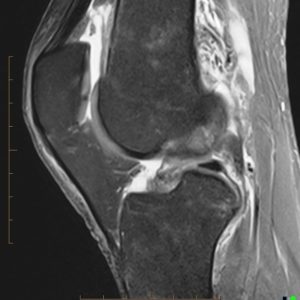 Rách dây chằng chéo